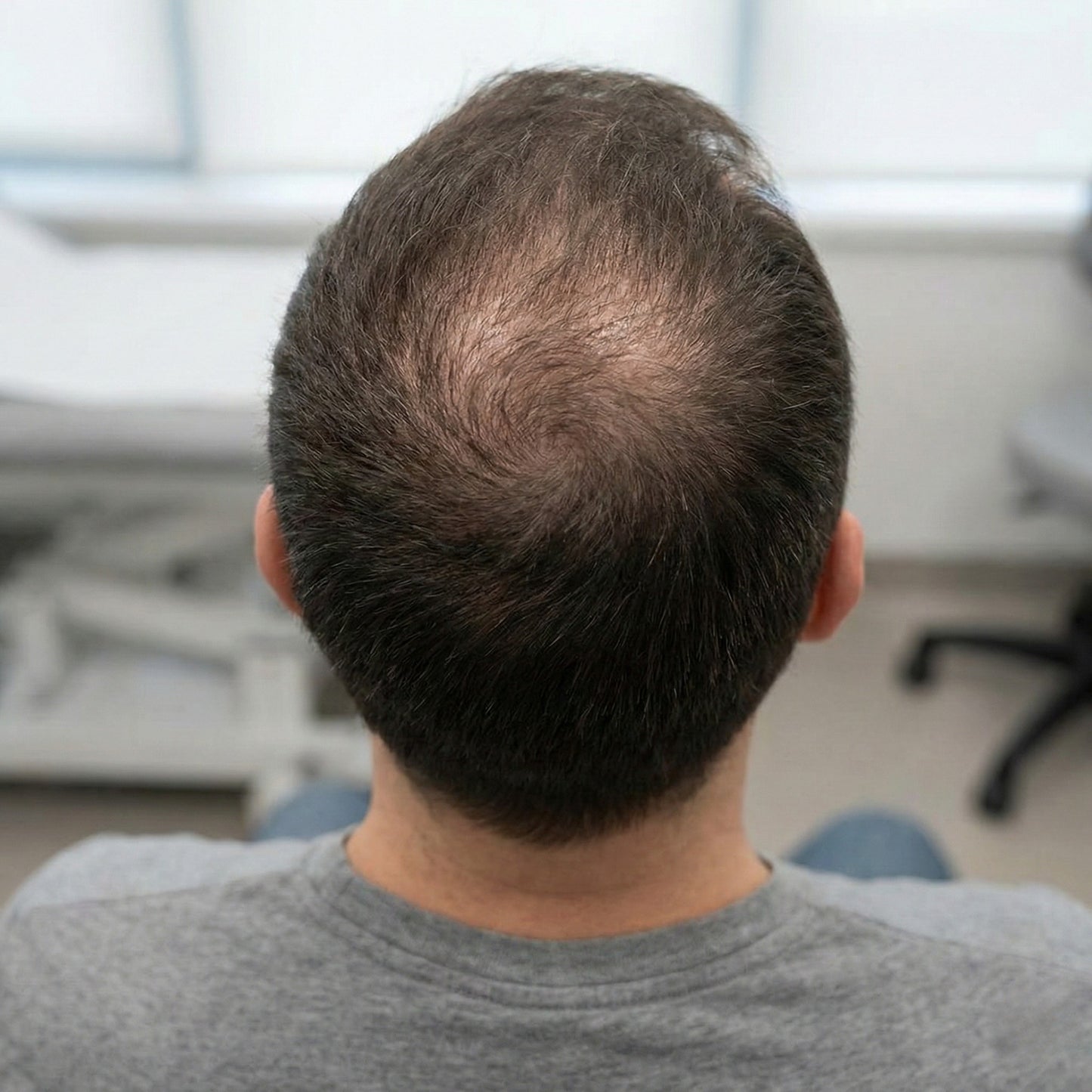 Man met geleidelijke haarverdunning bij de kruin